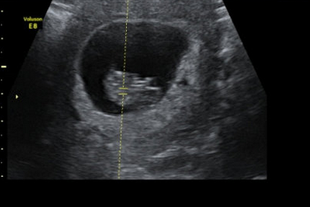 怀孕9周妊娠囊有多大