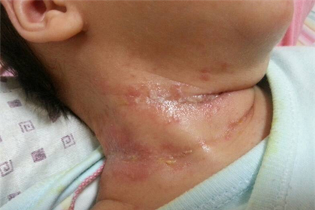 宝宝淹脖子是怎么回事