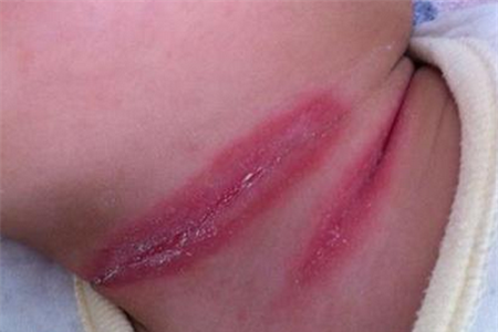 宝宝脖子淹了怎么办