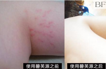 怎样去除腿上的妊娠纹 腿上的妊娠纹能去除吗