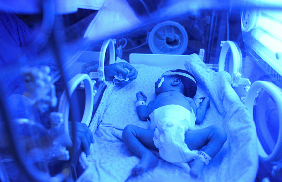 新生儿黄疸高照蓝光有什么影响