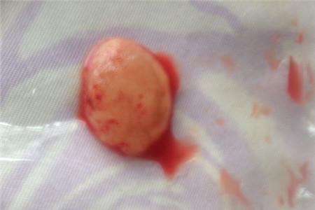 滑胎流出来的是什么