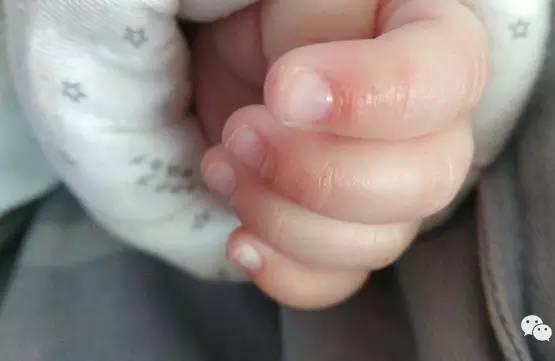 宝宝手指长倒刺是缺了啥？