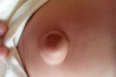 小儿脐疝，妈妈不要慌，教你怎么办？