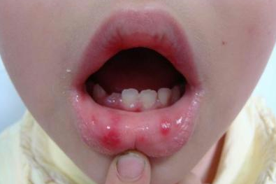 疱疹性咽峡炎和手足口病的区别