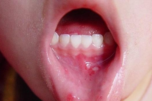 疱疹性咽峡炎潜伏期多久