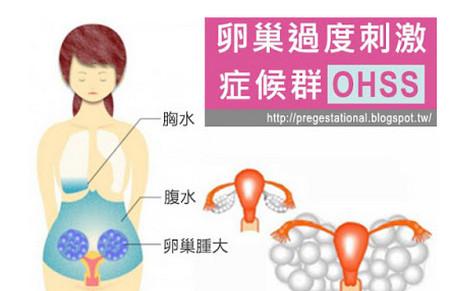 OHSS 卵巢过度刺激症候群－排卵药物后遗症