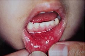 疱疹性咽峡炎会变成手足口吗