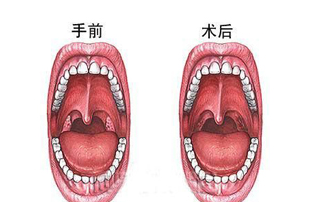 扁桃体摘除术