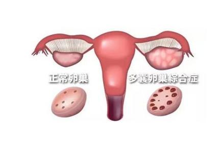 多囊性卵巢