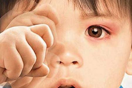 宝宝流出黄色眼泪，警惕这些眼病找上门！