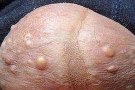 睾丸上有小疙瘩