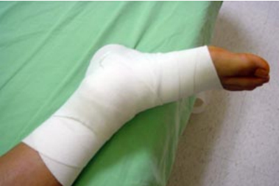 脚扭伤肿了怎么消肿