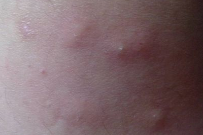 身上起红疙瘩很痒像蚊子咬的