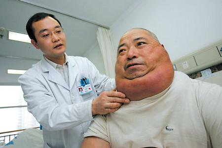 脂肪瘤怎么去除小窍门