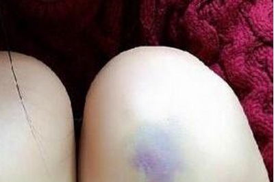 淤青怎么快速消除