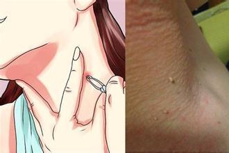 脖子上长了个硬疙瘩