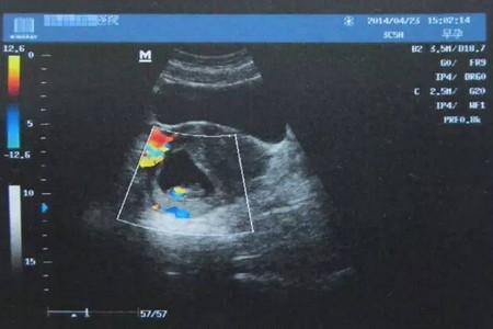 7次B超生下残疾宝宝，火爆的三维四维真那么靠谱？