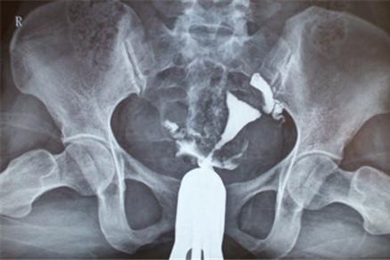 输卵管造影检查步骤