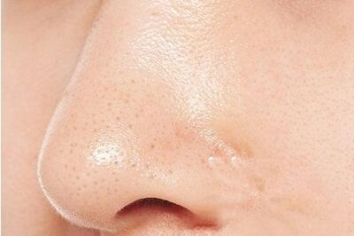 黑头怎么去除简单方法