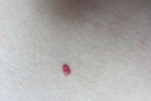 身上长小红点不痛不痒