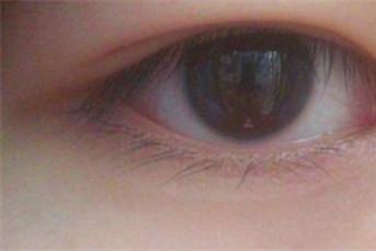 眼皮肿是怎么回事