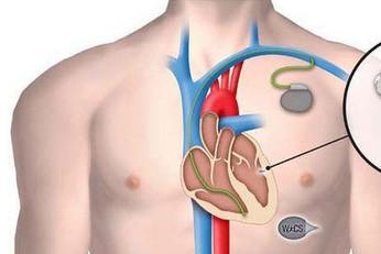 心脏起搏器