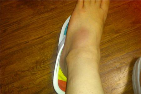 脚扭伤了怎么恢复最快