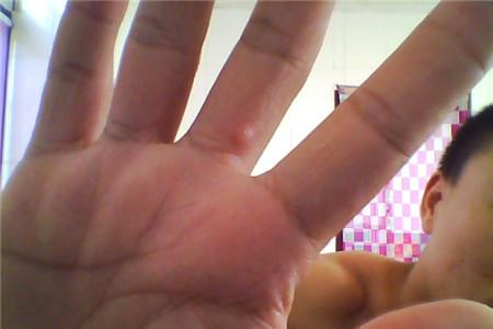 手上长了个硬疙瘩