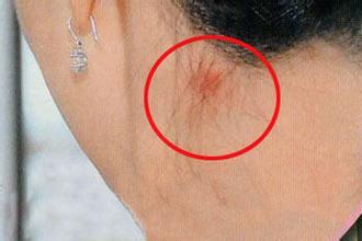 草莓印怎么尽快消下去