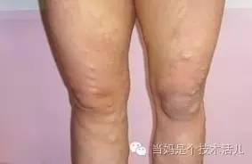 孕晚期变成这样也太难看了吧！准妈该怎样预防？