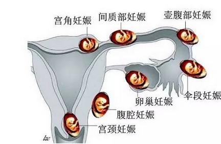 这些症状可能是宫外孕，准妈要及早去医院检查！