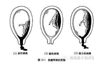 孕晚期出现这个症状必须立即就医，可能导致产妇和胎儿出现生命危险！