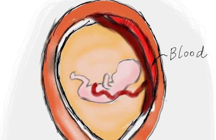 胎盘出问题，也可以要了宝贝的命！