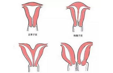 子宫也分“一室”和“二室”你不知道？