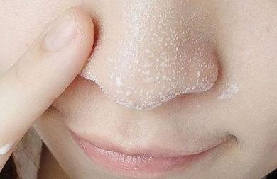 怎么去黑头最快最有效