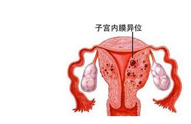 忽视子宫内膜健康，竟然有如此严重后果！