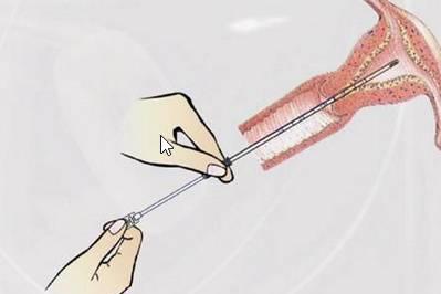 刮宫手术过程图片