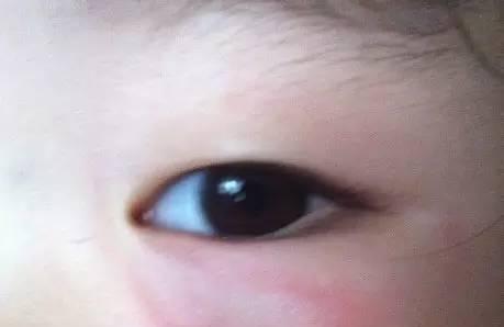 儿童常见皮肤问题--虫咬皮炎