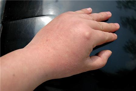 身上起了好多像蚊子咬的包