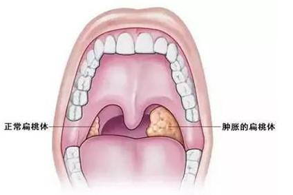 扁桃体和阑尾切除有助生育？