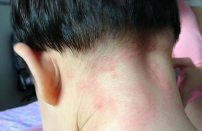 宝宝秋季荨麻疹的症状有哪些