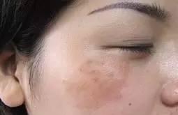 这些准妈孕期容易长出满脸蝴蝶斑，一定要这样预防缓解！