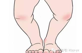 宝宝双腿内收危害如此严重，你注意了吗？