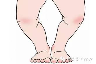 宝宝双腿内收危害如此严重，你注意了吗？