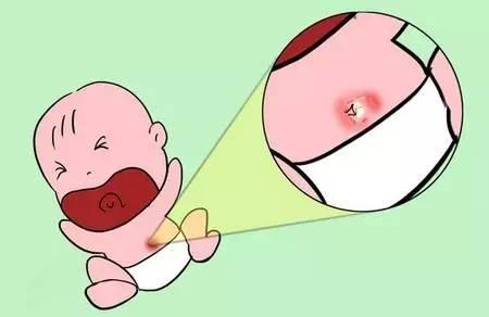 宝宝肚脐有肿块原来大哭是祸首