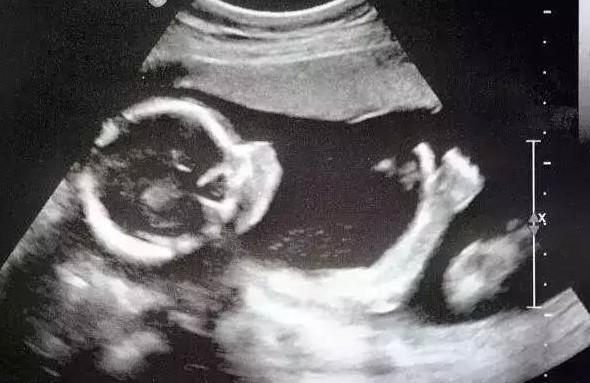 一张胎儿B超图，竟被点击百万次，太有爱了！
