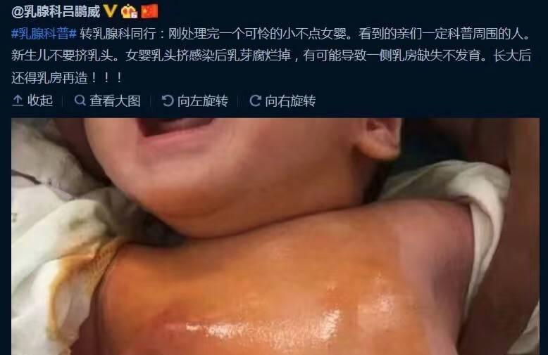 新生宝宝必须挤乳头？看看这都挤成什么样了！