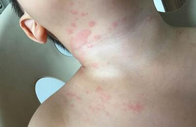 儿童秋季荨麻疹症状及治疗方法