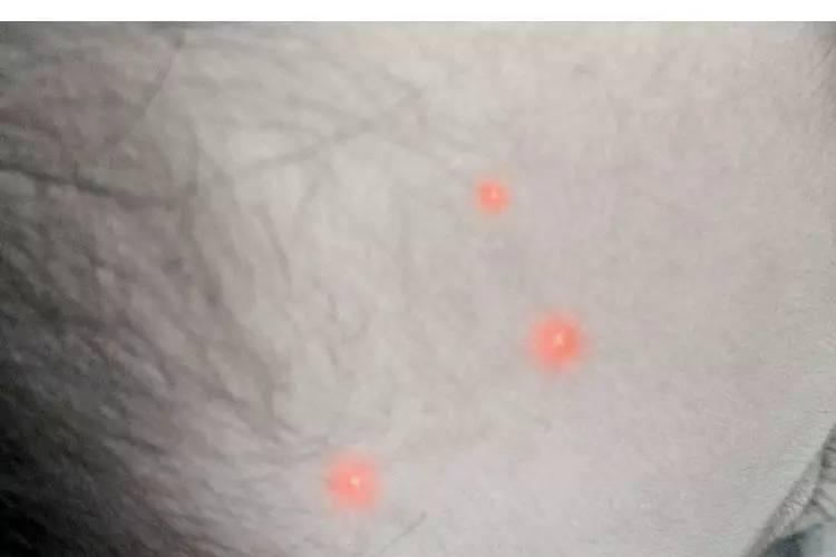 热疖头：不抓不挠也肿痛，抓破挠破更严重